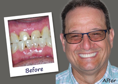 Barry hid his smile until the All-on-4 treatment. Now, he can smile, eat and talk confidently.
